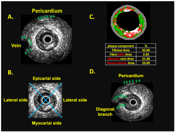 Ενδοστεφανιαίο Υπερηχογράφημα (IVUS)